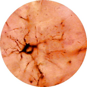 Imagen de una oligodendrogla
