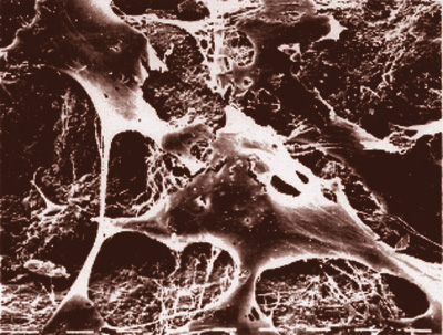 Clulas seas en huecos del tejido seo